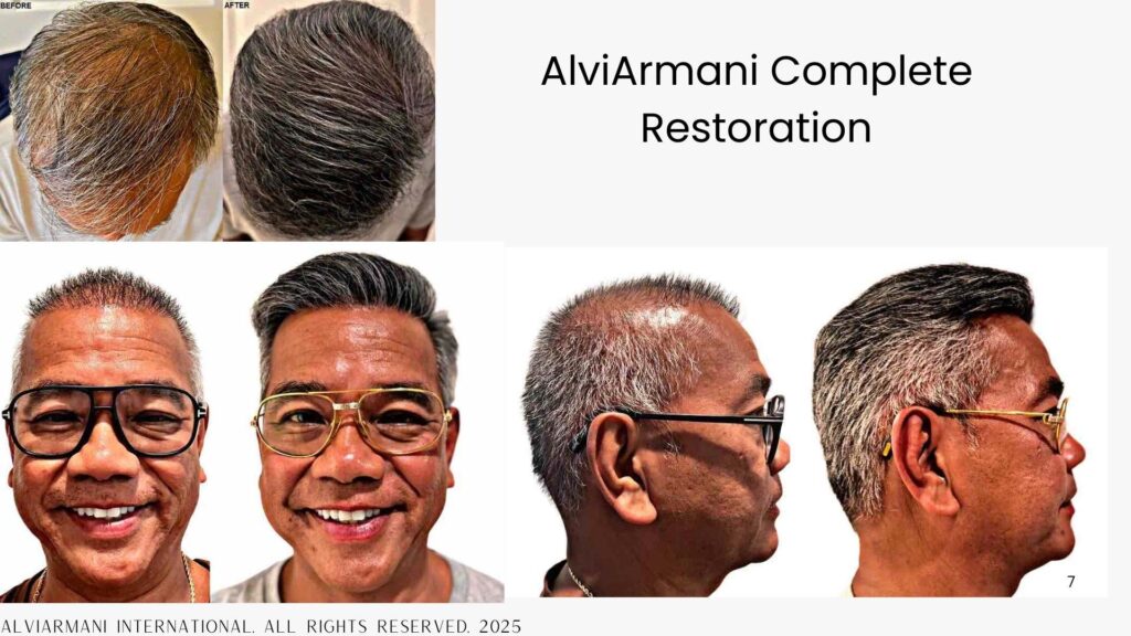 Asian Hair Transplant FUE Method At AlviArmani