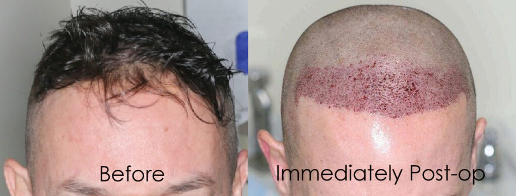 Before after Hairline Lowring