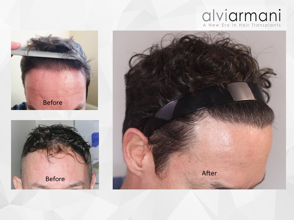 Slide229 Hairline Lowering Procedure AlviArmani Leaders In FUE