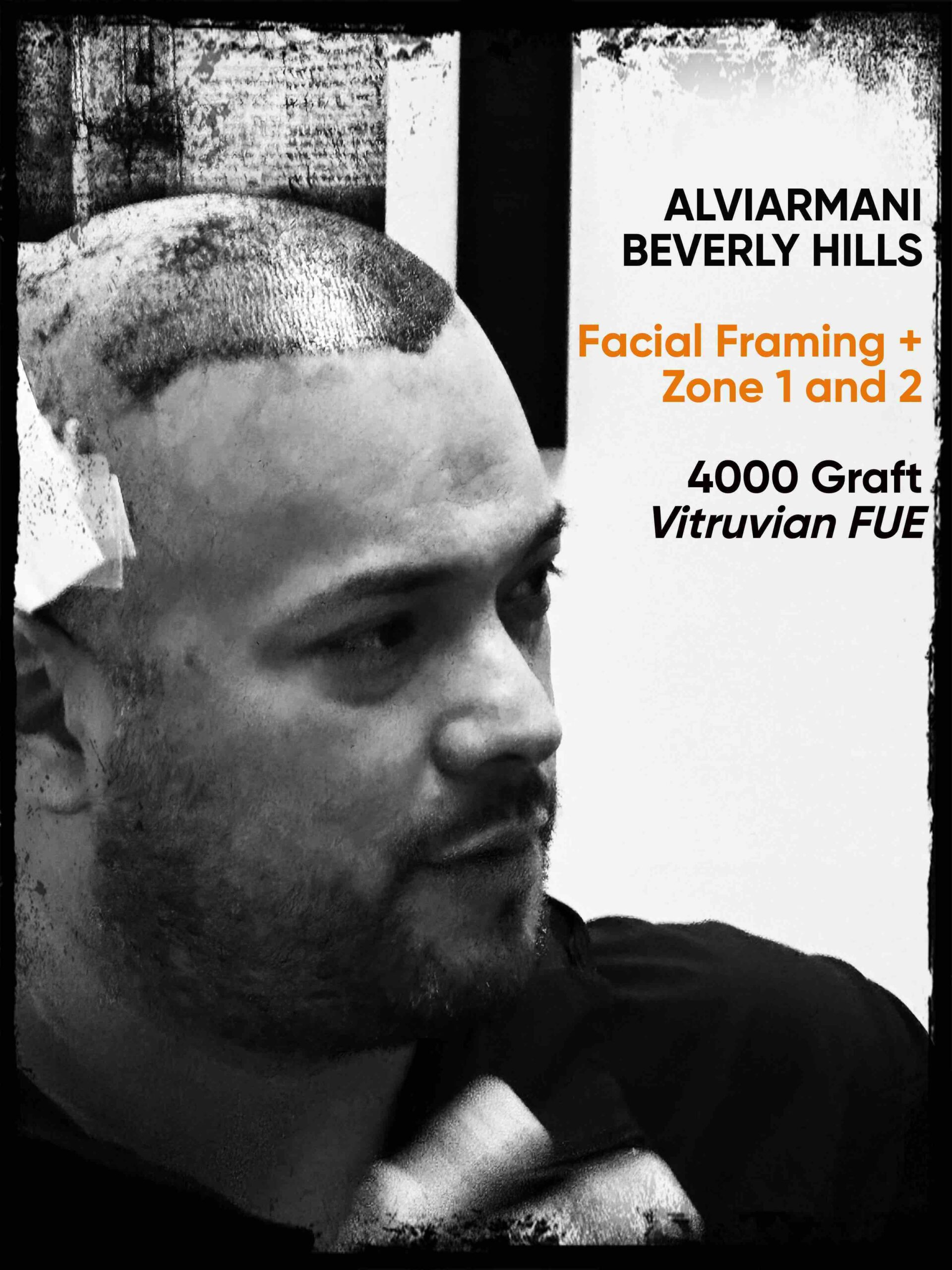 AlexM AlviArmani Hair Transplant Reviews 4000 graft case Maximus FUE Hair Transplant