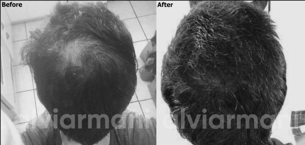 Exosomes For Hair Loss Before and After Results