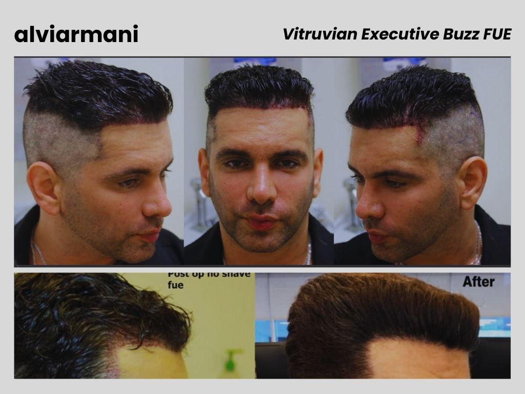Vitruvian Executive Buzz No Shave FUE Hair Transplant AlviArmani