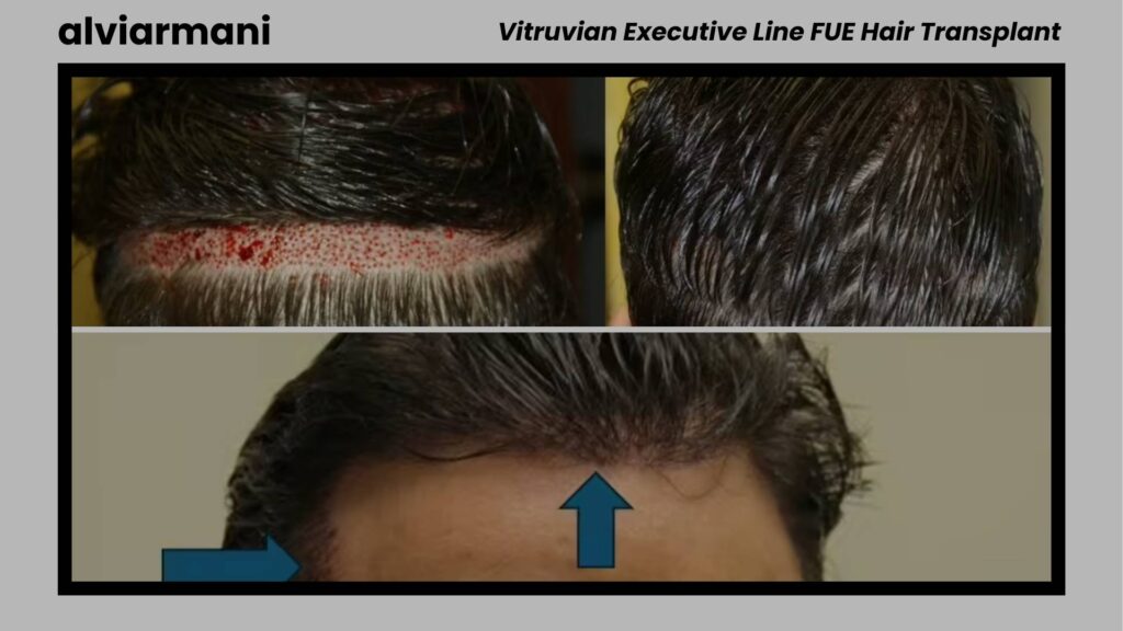 AlviArmani Vitruvian Executive Line No Shave FUE Hair Transplant