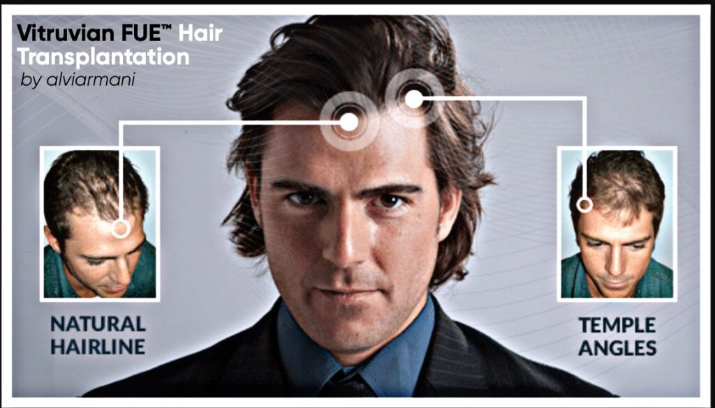 Vitruivan FUE Hair Transplantation - AlviArmani