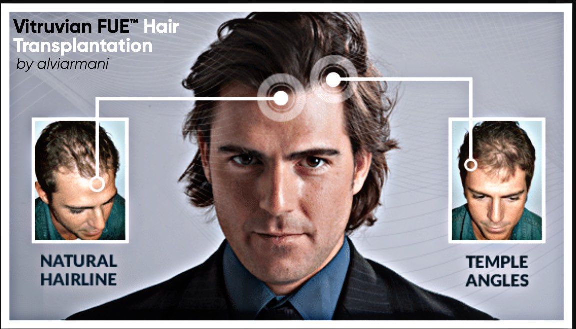 Vitruvian FUE Hair Transplant-2 Vitruivan FUE Hair Transplantation - AlviArmani