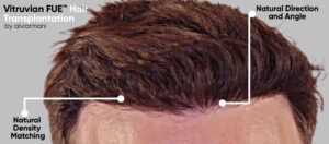 Vitruvian FUE Hair Transplant in Utah - AlviArmani