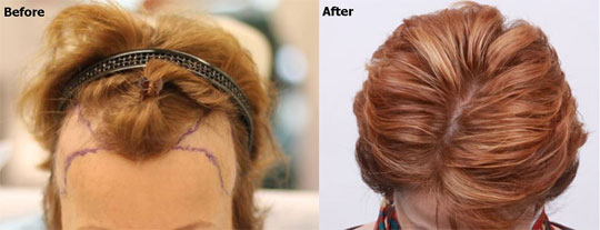 Female FUE Hair Transplant. - AlviArmani