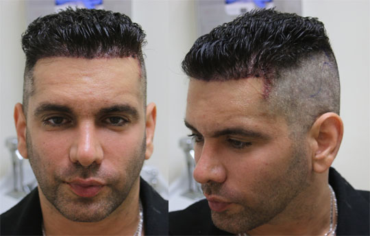 No Shave FUE Buzzed Hair Transplant Option from AlviArmani