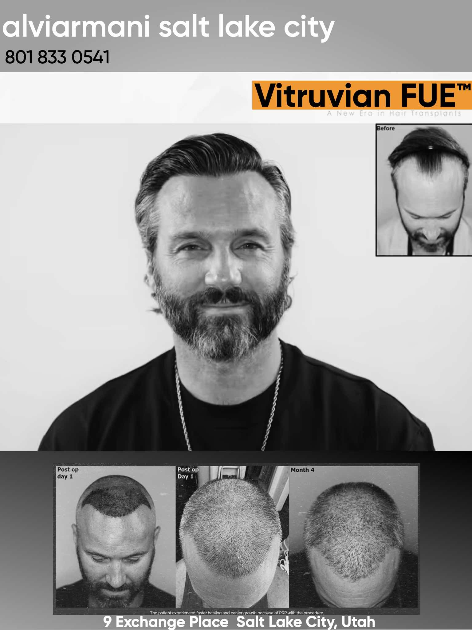 Before, Post op, and After FUE result Utah FUE Hair Restoration Result AlviArmani