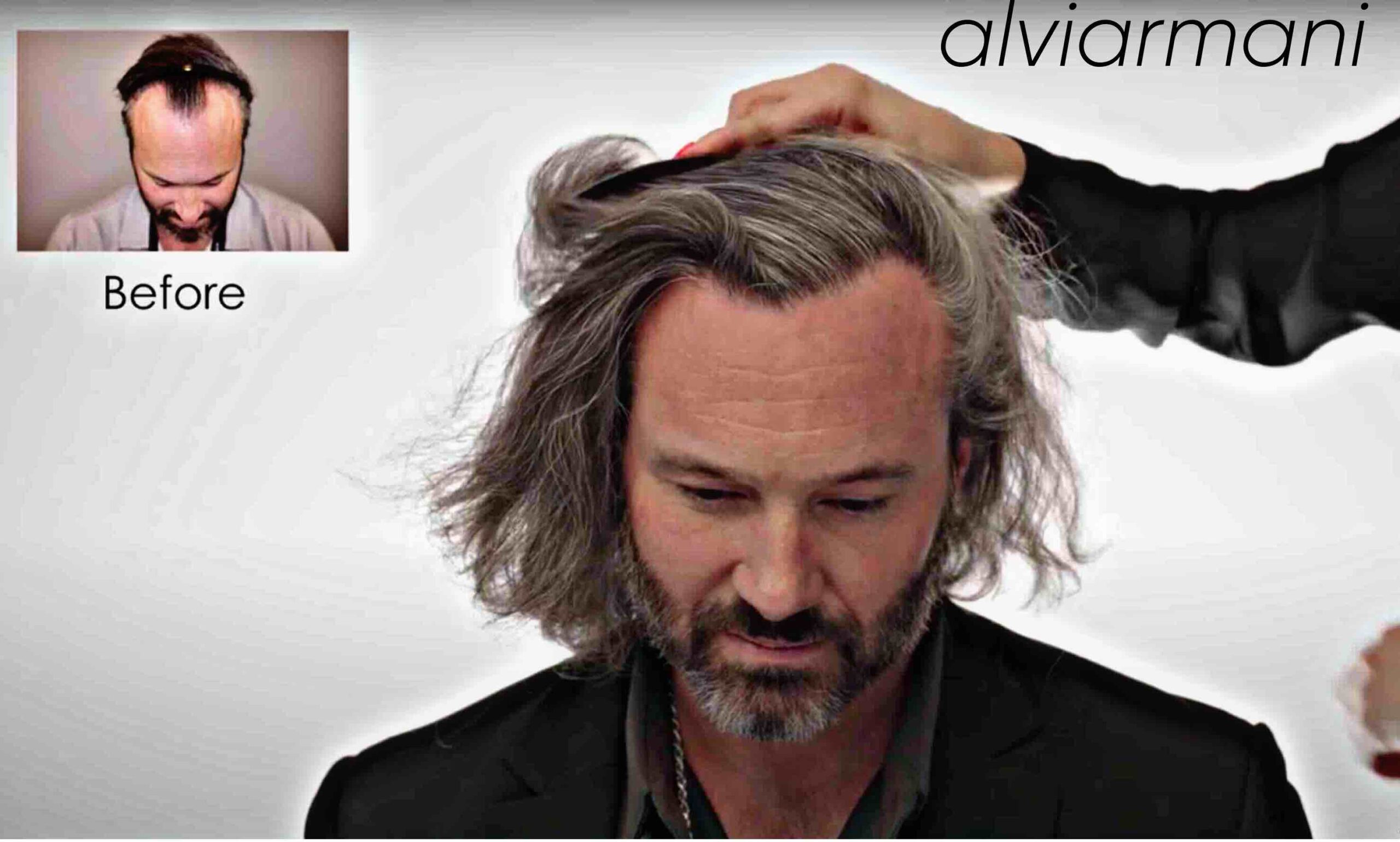 2 Staged Vitruvian FUE Utah Hair Restoration