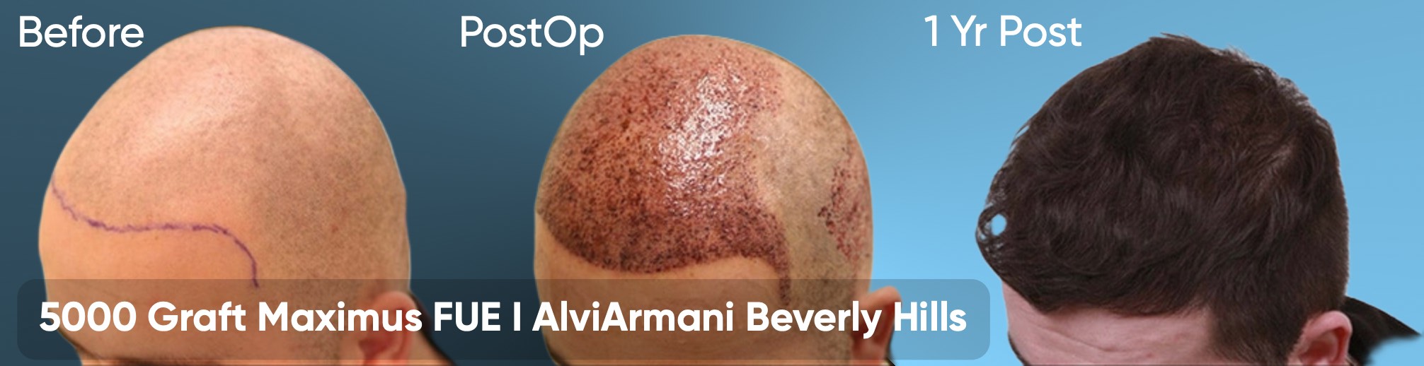 Maximus FUE 5000 Graft Maximus FUE Hair Transplant 5000 Grafts