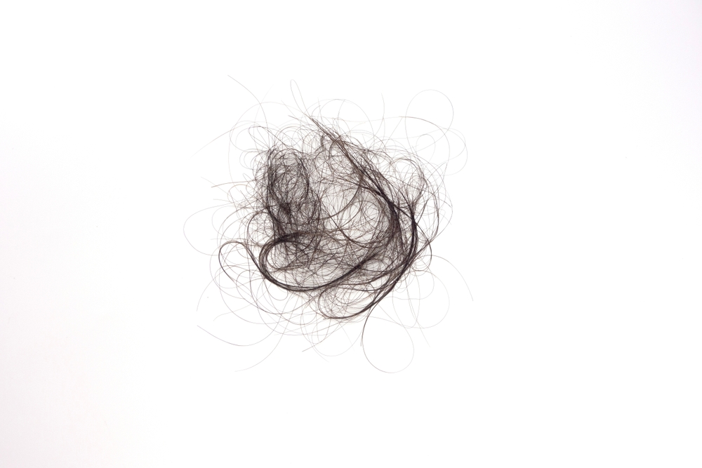 Hair loss pattern example