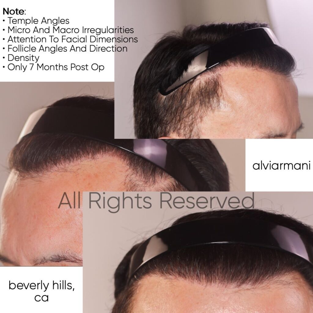 Temple Angle Results After FUE