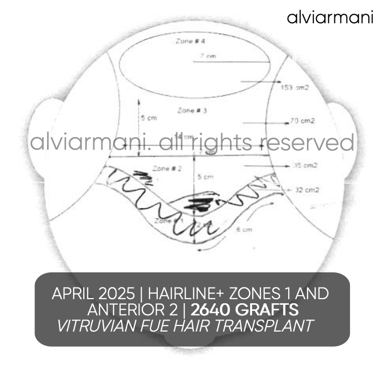 Before and after composite &mdash; 2640-graft Vitruvian FUE in Beverly Hills