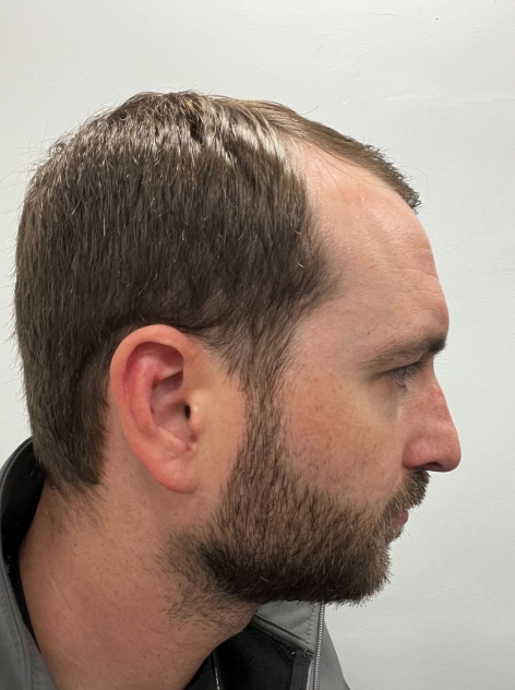 Before — side profile