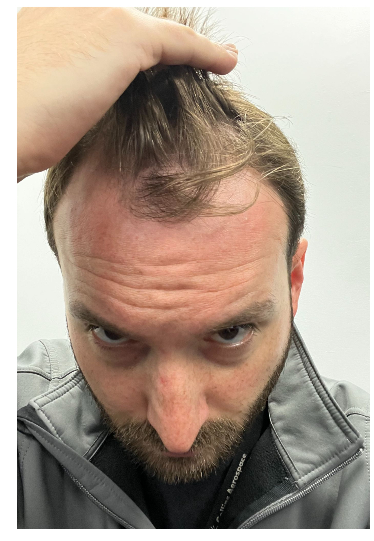 Before — frontal profile