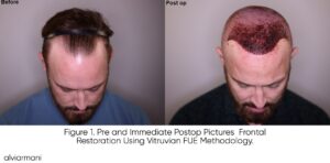 Before and Post Op Vitruvian FUE facial framing procedure