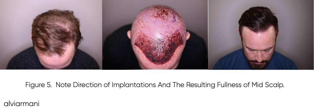 Starting appearance, operative placement and later mid-scalp appearance in a three-panel hair transplant comparison