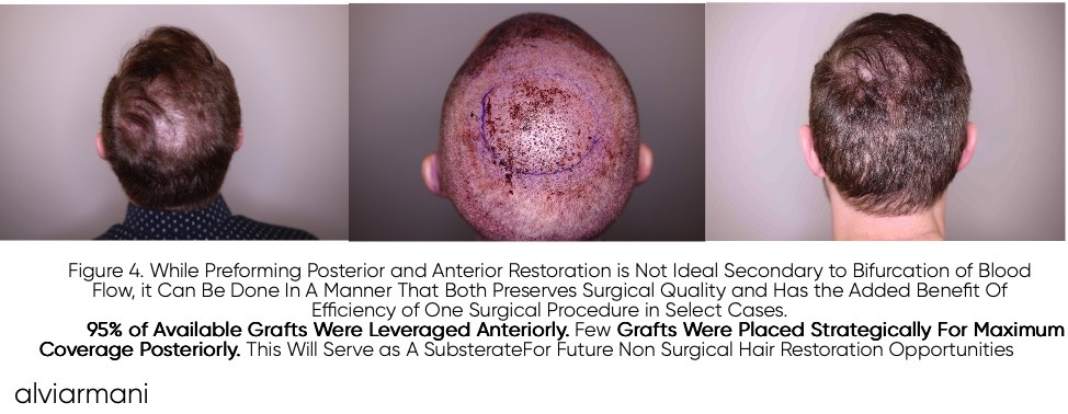 Posterior planning evidence showing limited Zone 4 graft placement during 3,600-graft Vitruvian FUE