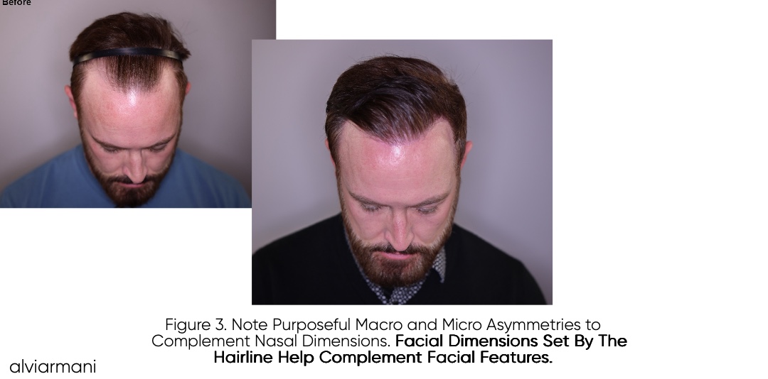 Patient photographs from the 3,600-graft Vitruvian FUE hairline hair transplantation and transition-planning case