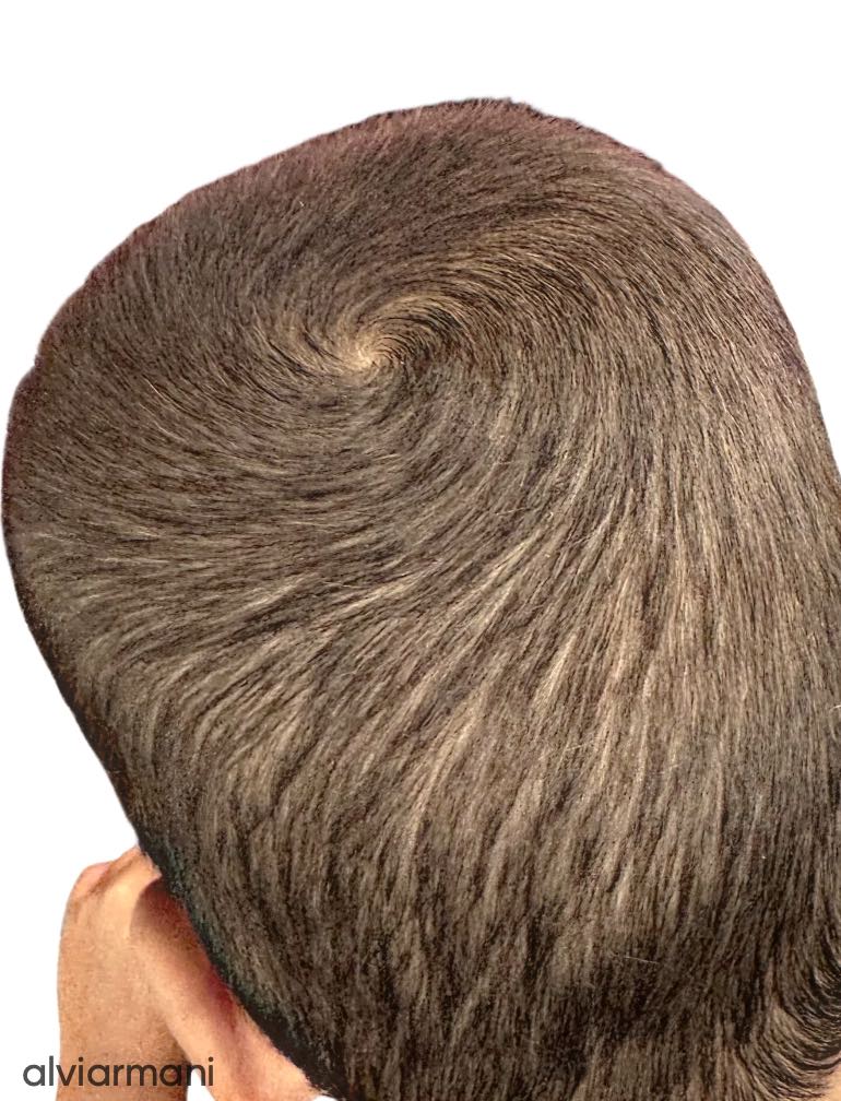 Natural crown whorl demonstrating vortex architecture, with hair shafts radiating from a central vortex.