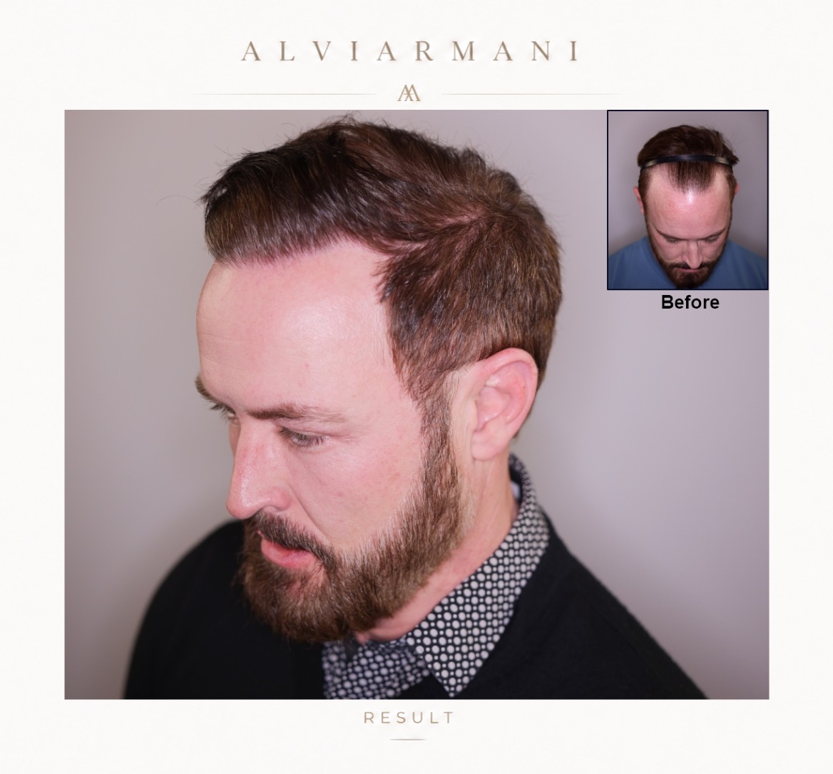 3600 graft hairline restoration Vitruvian FUE before and after case