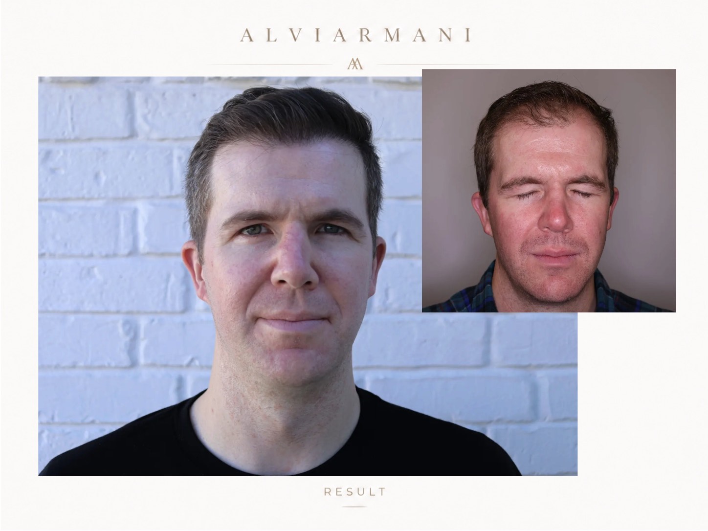 AlviArmani patient result showing 2066 graft frontal restoration before and after