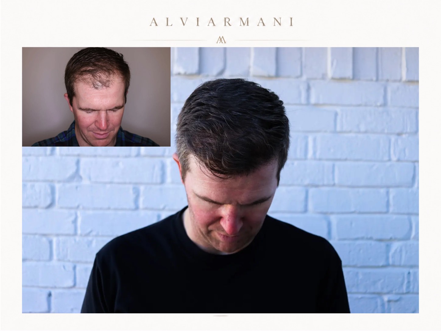 AlviArmani 2066 graft frontal restoration FUE case image