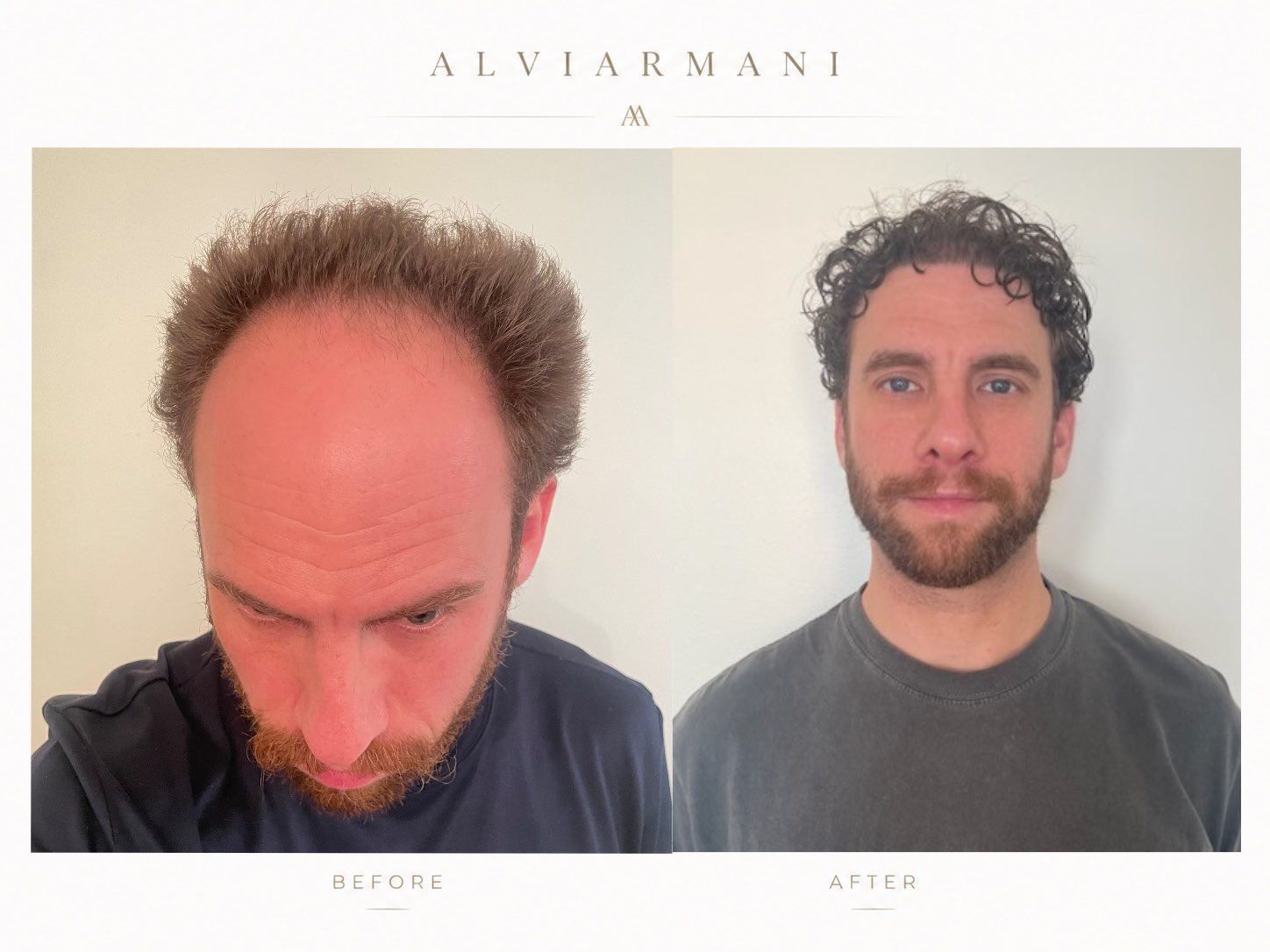 Before and after image of a 4,135-graft AlviArmani frontal mega session focused on zones 1 and 2