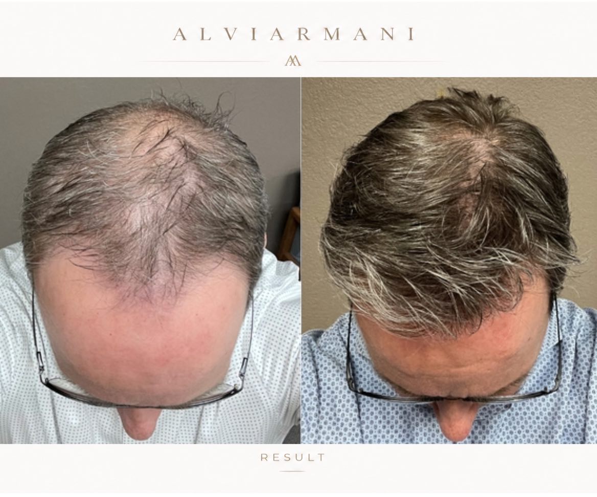 AlviArmani frontal restoration with mid-zone density photographed 9 months post-procedure