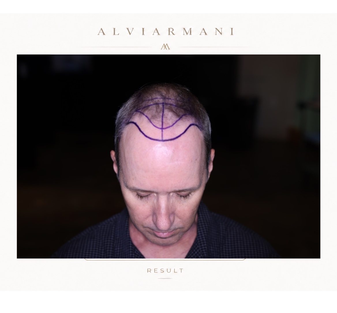 AlviArmani Salt Lake frontal hair restoration result with 3,190 grafts at 9 months post-procedure