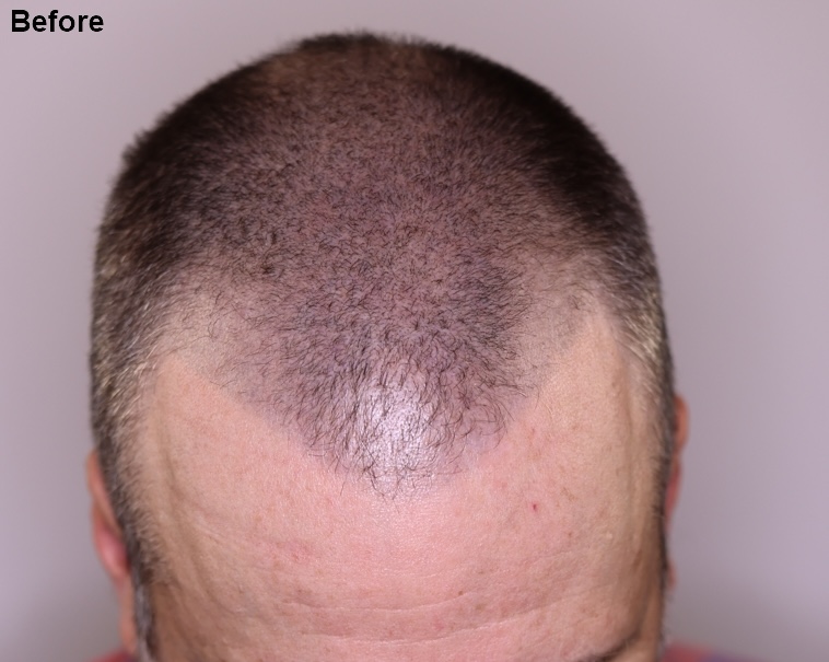 Before image showing prior SMP before 3,080 graft frontal restoration