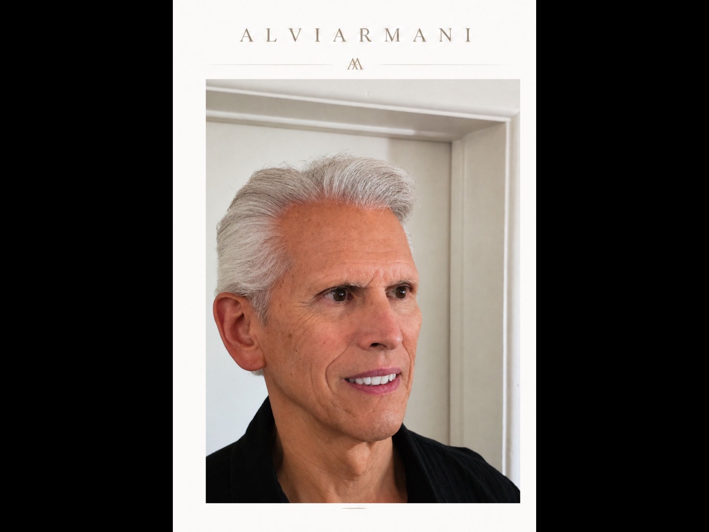 3,078-graft FUE hair transplant result by Dr. Michelle Ischayek