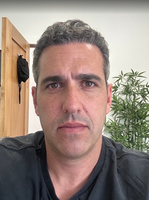 Frontal appearance nine months after a 4,054-graft FUE hair transplant
