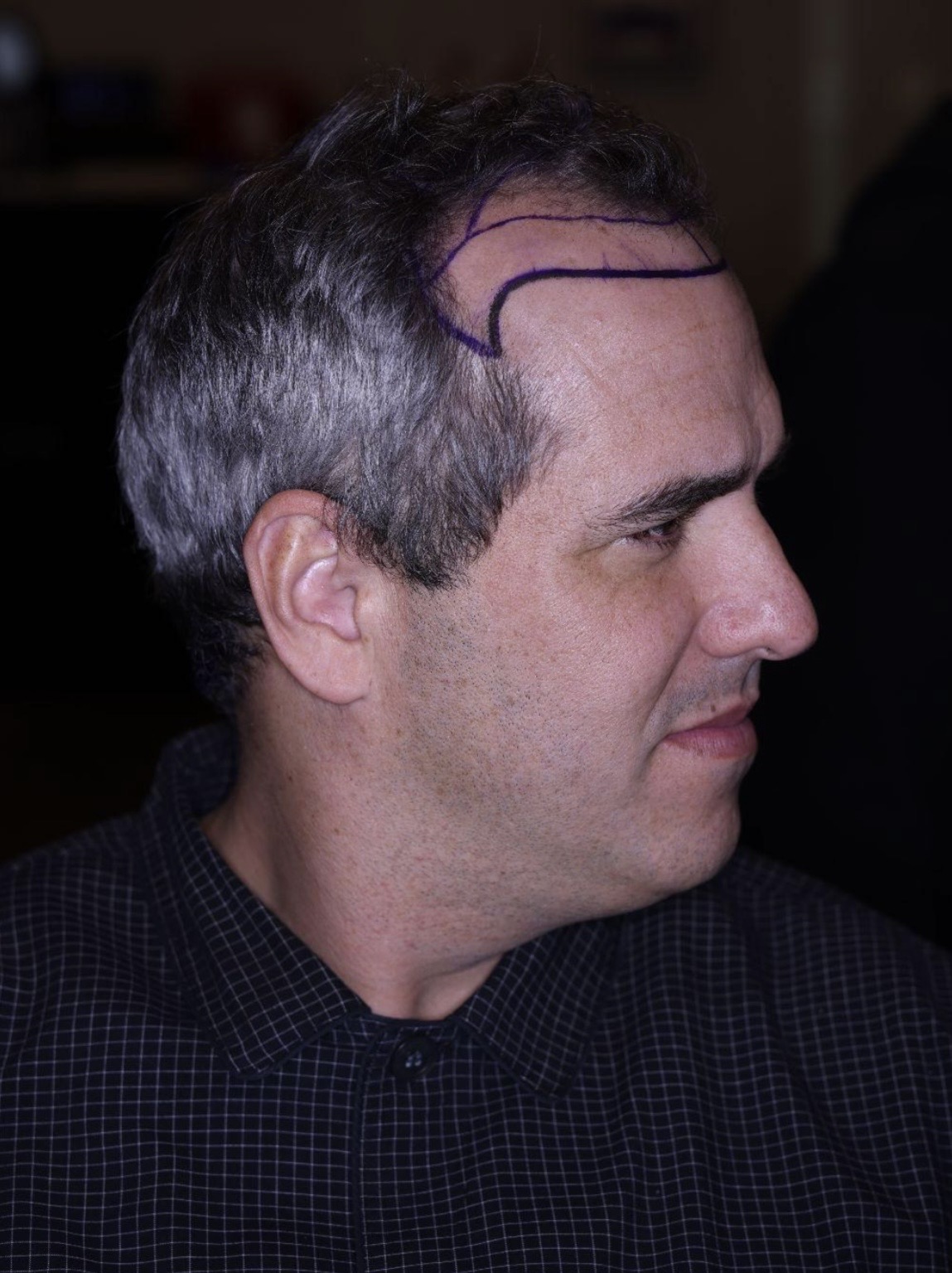 Preoperative side view showing the planned frontal hairline
