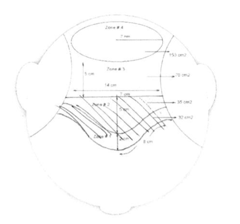 Surgical design plan for 3,078-graft FUE hair transplant