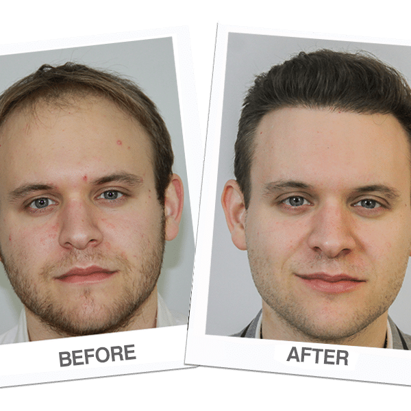 Hair Transplant Los Angeles Before and After