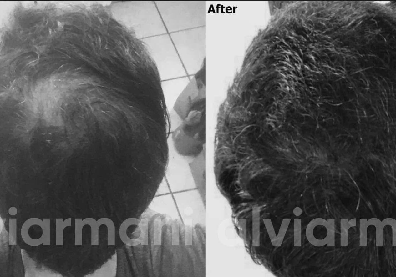 Exosomes Before And After Exosomes For Hair Loss Before and After Results