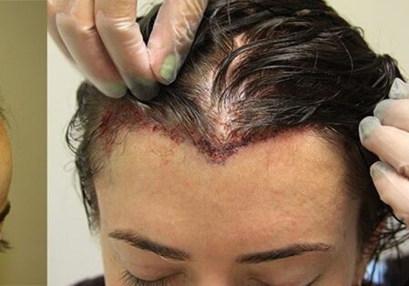 Female No Shave FUE Hair Transplant At AlviArmani