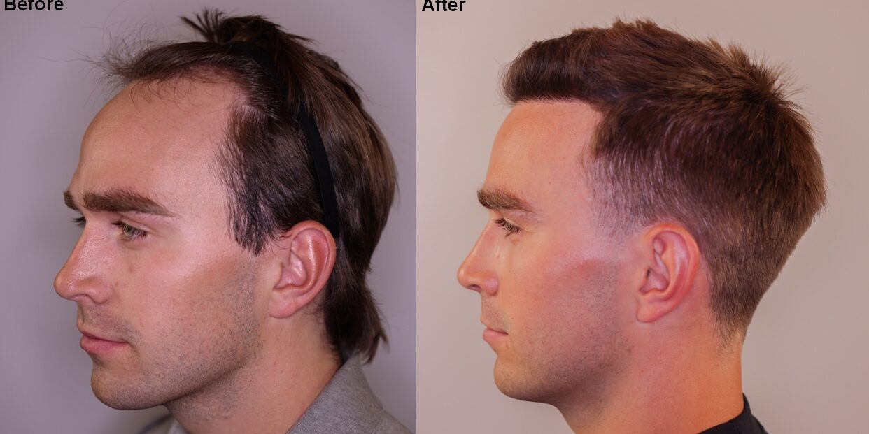Before After Vitruvian FUE Hair Transplant Utah